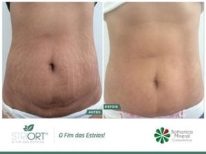 método striort para estrias em brasilia df bio renew clínica estética