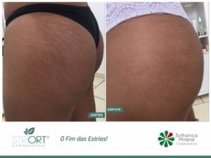 método striort para estrias em brasilia df bio renew clínica estética