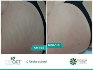 método striort para estrias em brasilia df bio renew clínica estética
