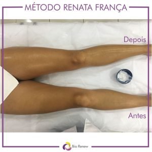 antes e depois método renata frança asa norte bio renew clinica estética