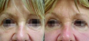 radiofrequencia facial rea dos olhos antes e depois endymed biorenew clinica de estetica brasilia