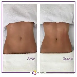 DRENAGEM LINFÁTICA MÉTODO RENATA FRANÇA Brasilia DF para celulites, retenção de líquidos, gordura localizada e flacidez