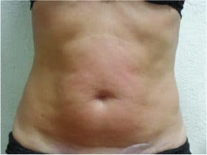 endymed antes e depois barriga