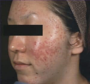 tratamento-cicatrizes-acne-antes-e-depois-300x281