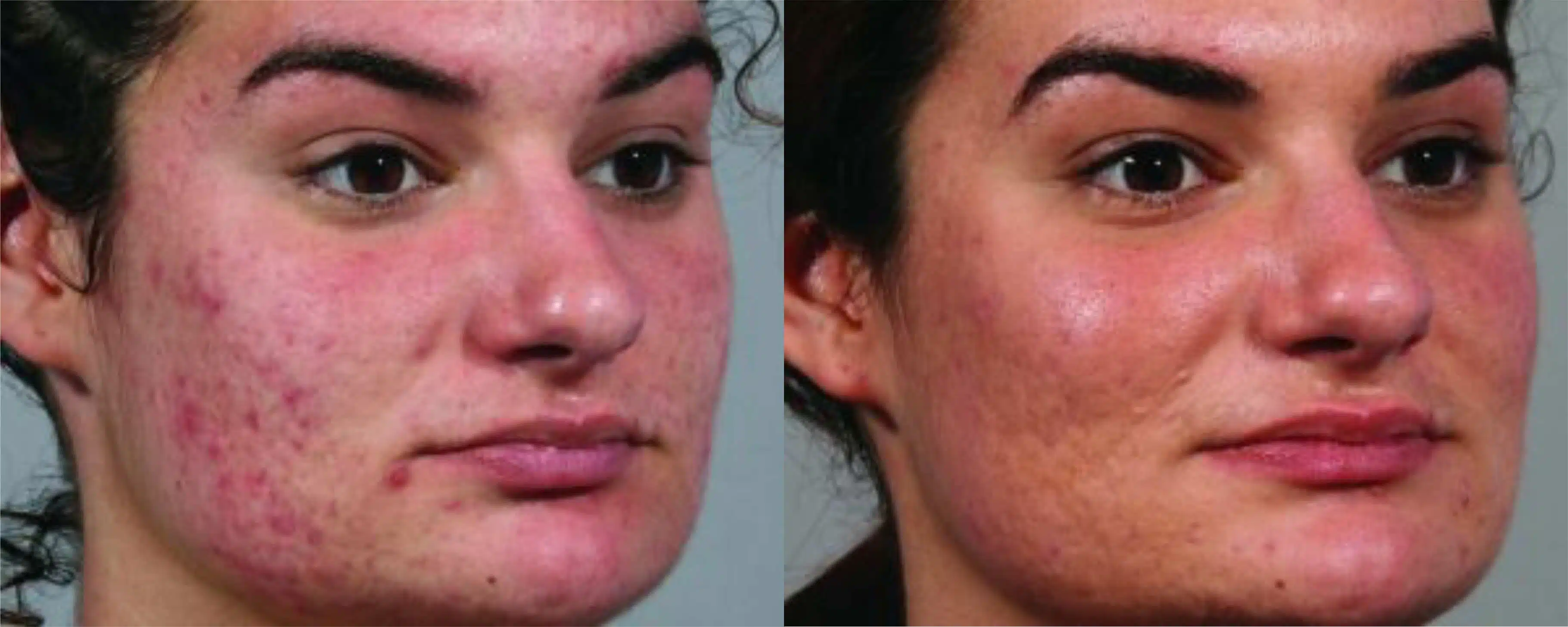 antes e depois endymed radiofrequencia em brasilia bio renew sua clinica de estetica em brasilia df