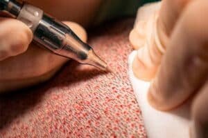 Implante Capilar na Bio Renew medicina estética