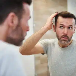 Alopecia androgenética