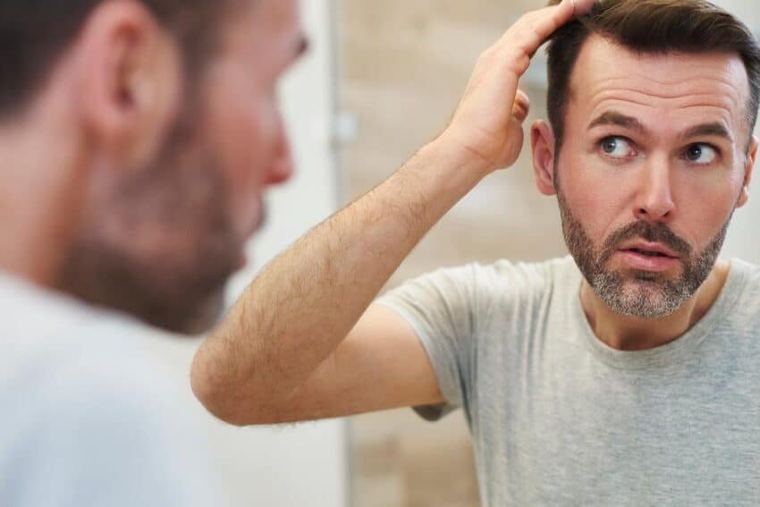 Alopecia androgenética