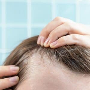 tratamento efluvio telogeno