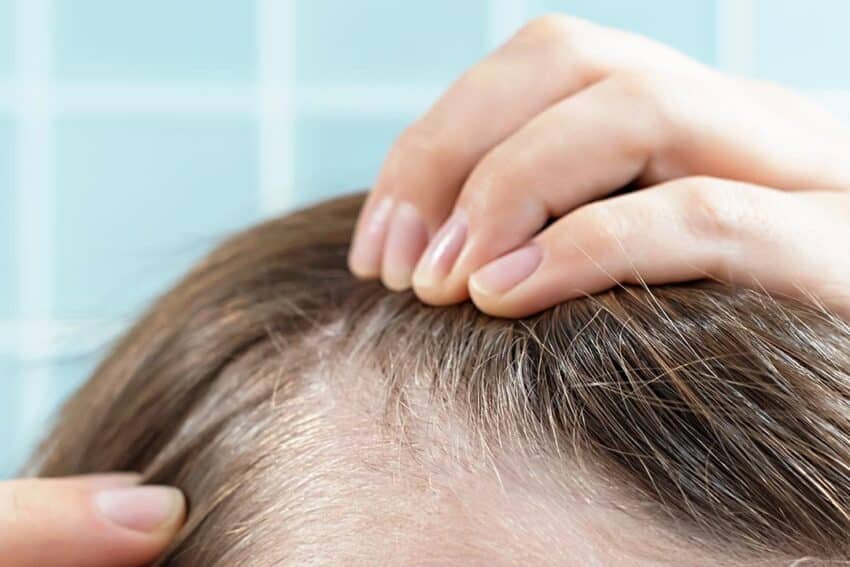 tratamento efluvio telogeno