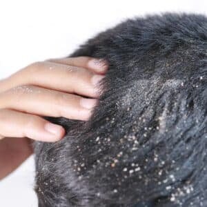 Como eliminar dermatite seborreica?