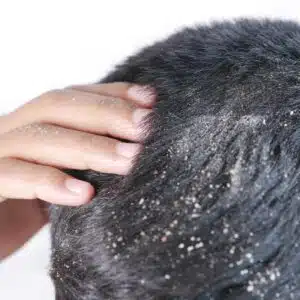 Como eliminar dermatite seborreica?