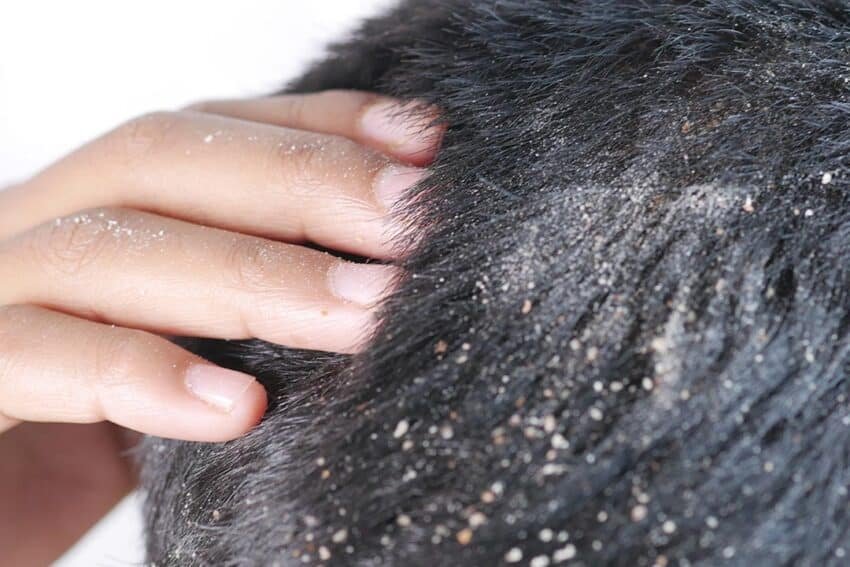 Como eliminar dermatite seborreica?