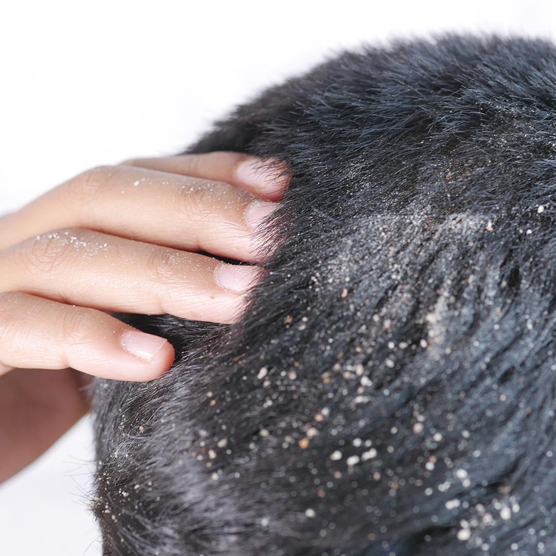 Como eliminar dermatite seborreica?