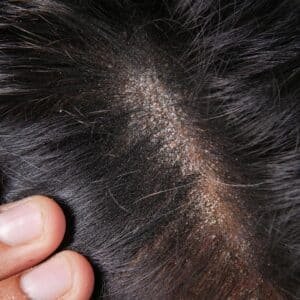 O que causa dermatite seborreica?