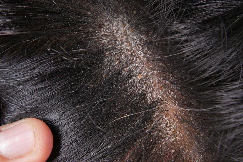 O que causa dermatite seborreica?