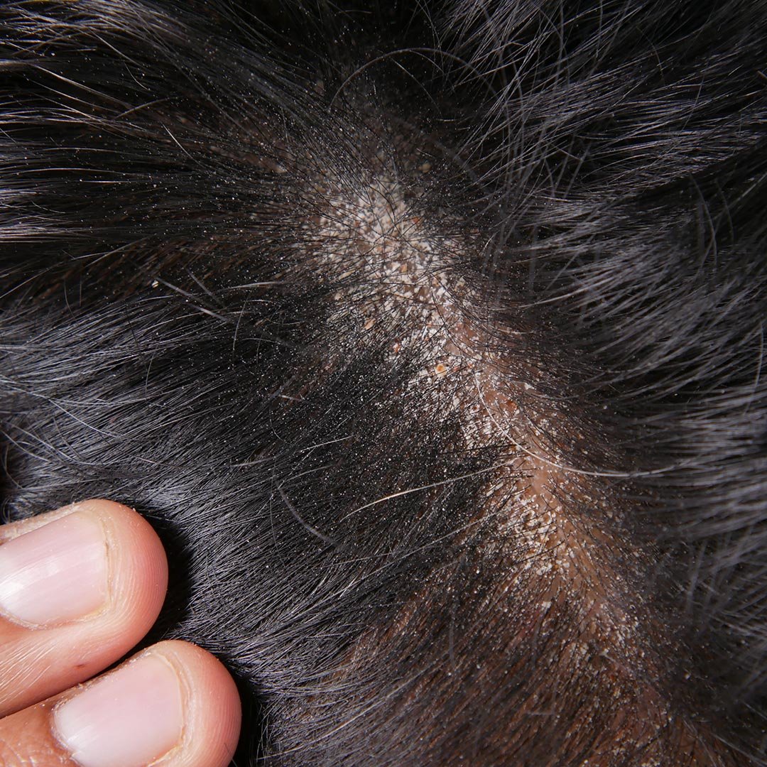 O que causa dermatite seborreica?